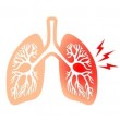 Пневмония и воспаление легких